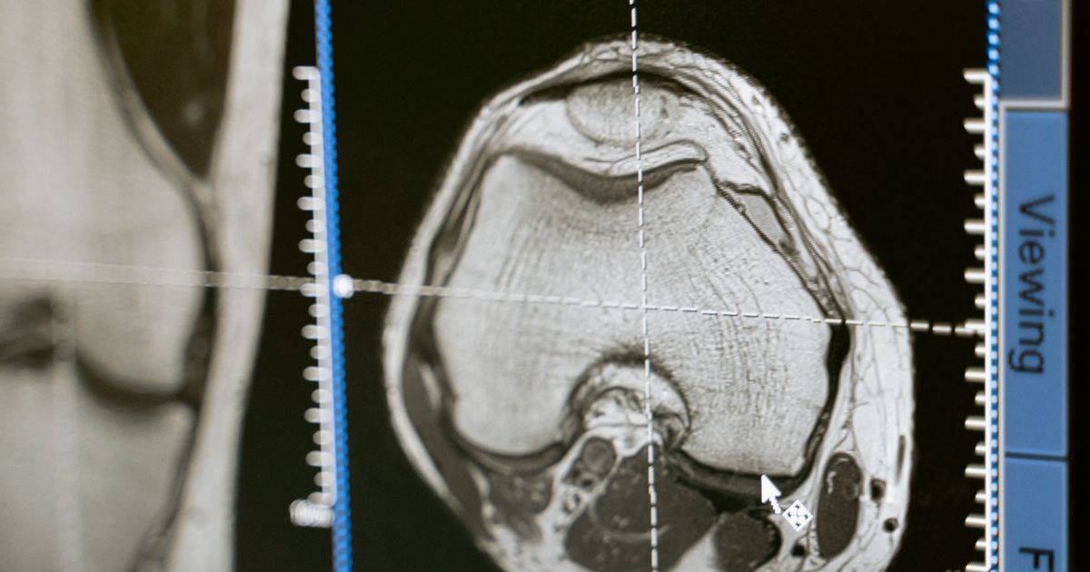 Understanding the Coronary Artery Calcium Scan Advantage